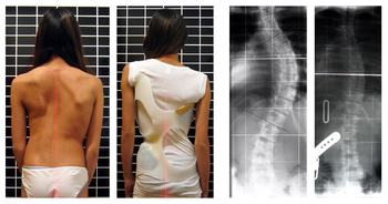 Mr. P. reccomend Mature adults with scoliosis