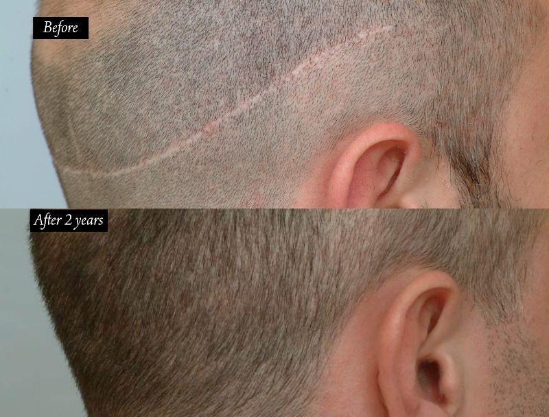 Wonka reccomend Shaved transplant scar