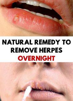 best of Facial Natural remedy herpes for