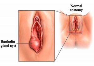 Hard spot in vulva