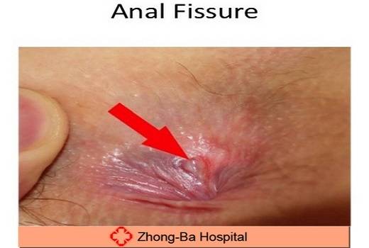 Bombay reccomend Anal fissure herpes pictures