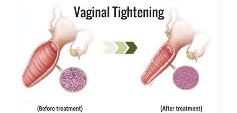 Cosmetic surgery on vagina