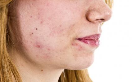 Ladybug reccomend Facial acne sores