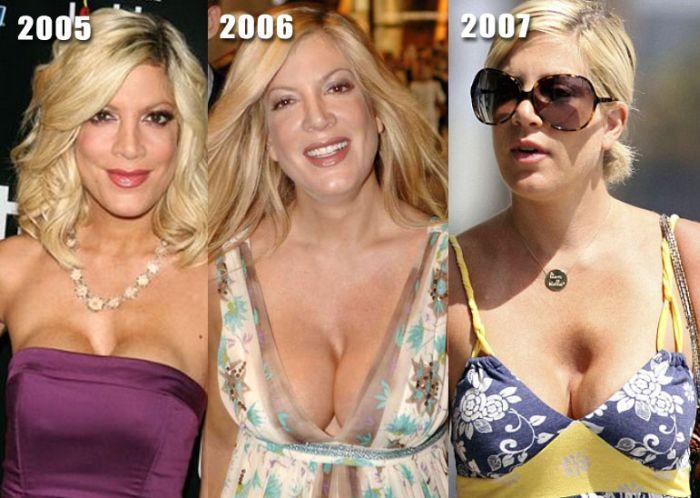 After before boob celebrity job