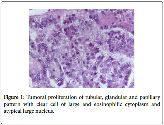 The L. reccomend Clear cell carcinoma of the vagina