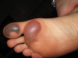 Terminator reccomend Itchy welt bottom of foot