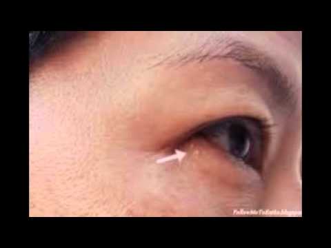 best of Skin rashes Eye lid facial