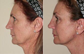 Dollface reccomend Facial exercises for loose neck skin