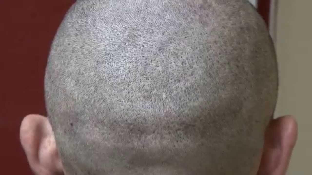 Shaved transplant scar