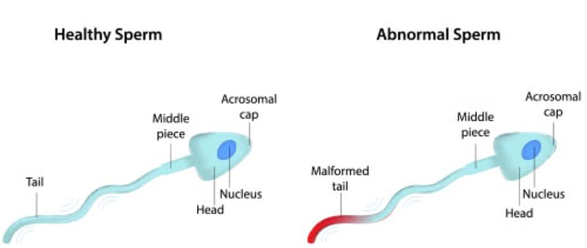 Male infertility + abnormal sperm
