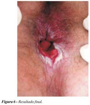 Hpv in anus pictures