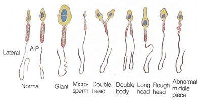 best of + sperm infertility Male abnormal