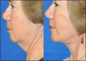 Serpentine reccomend Facial exercises for loose neck skin