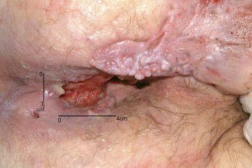 Peri anal rash differential diagnoses