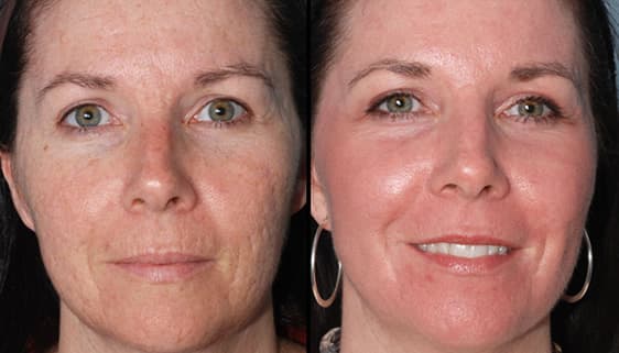 Laser treatment for facial scars