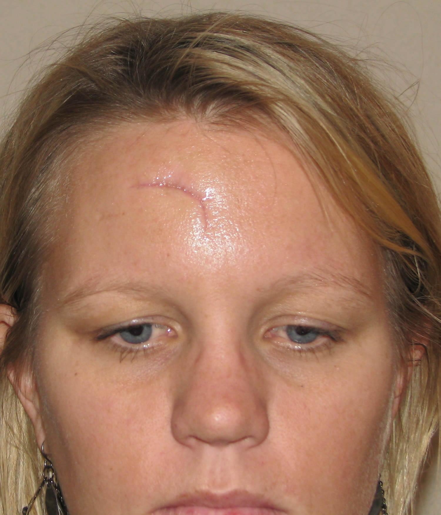Grasshopper reccomend Facial reconstructive surgery scars