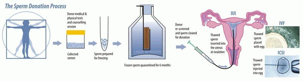best of Of donation Process sperm