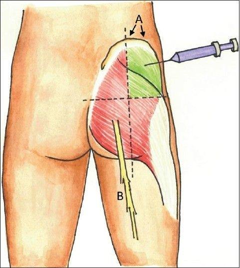 Im injection ass butt needle