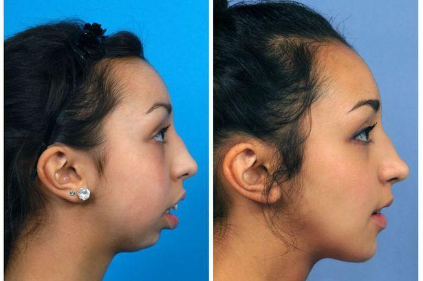 Facial deformity surgery