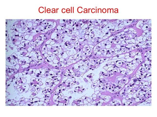 Goldfinger reccomend Clear cell carcinoma of the vagina