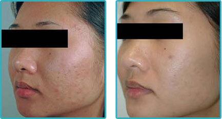 Laser treatment for facial scars
