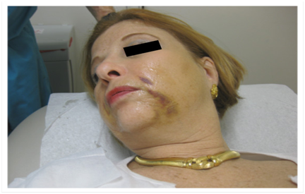 Permanent numbness after facial lift