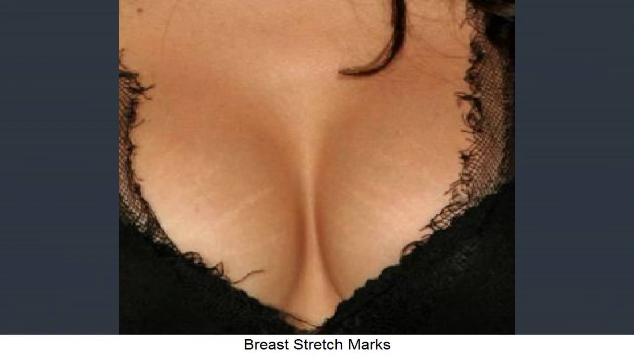 Help boob stretch marks