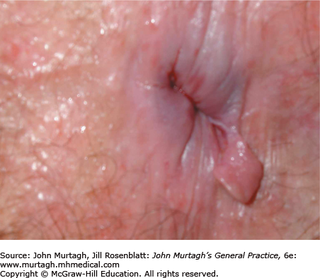Viper reccomend Anal fissure herpes pictures