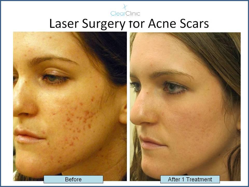 Bloomer reccomend Laser treatment for facial scars
