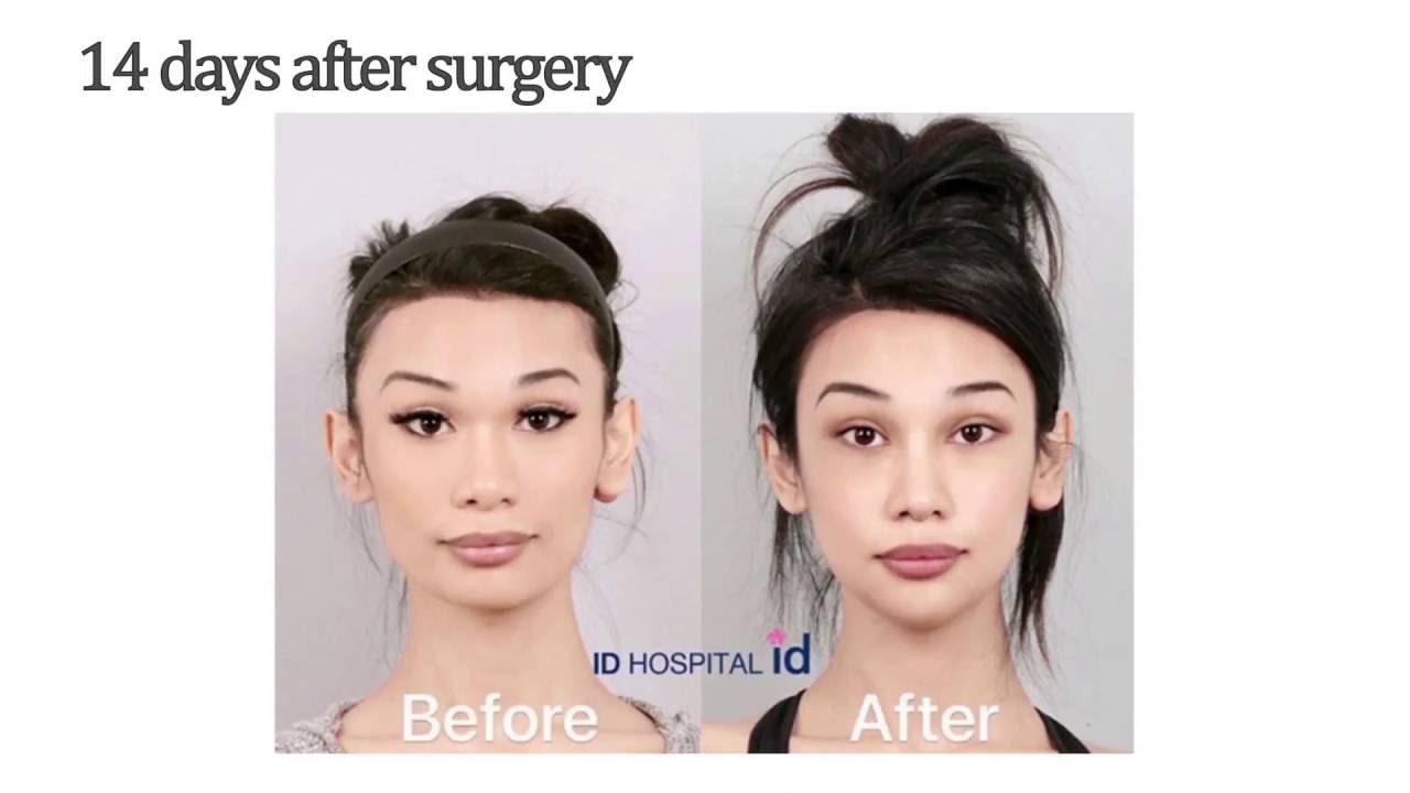 Asian Plastic Surgery Pictures Porn Tube
