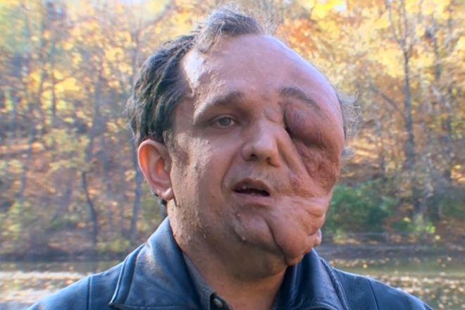 Man with giant facial tumor