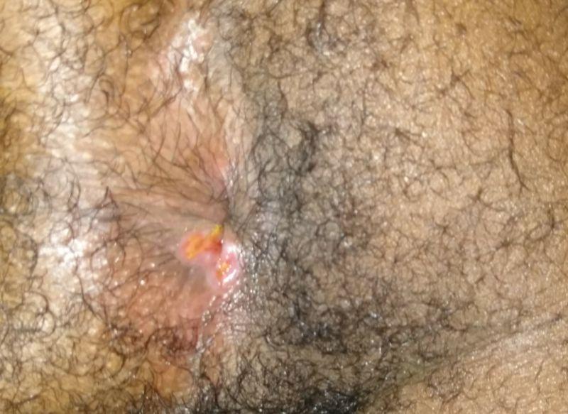 Booter reccomend Anal fissure herpes pictures