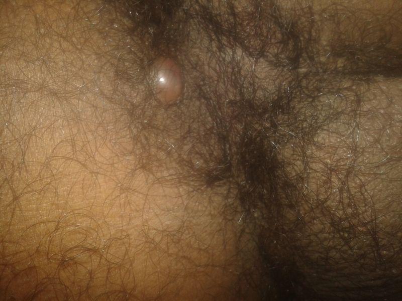 Itch bumps in the area around anus