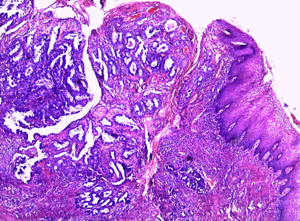 best of Of carcinoma vagina the cell Clear