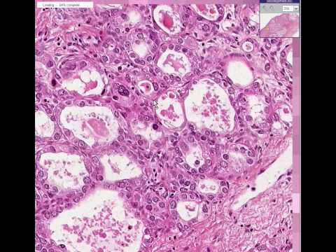 Thunderhead reccomend Clear cell carcinoma of the vagina