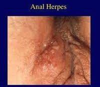 best of Pictures Anal fissure herpes