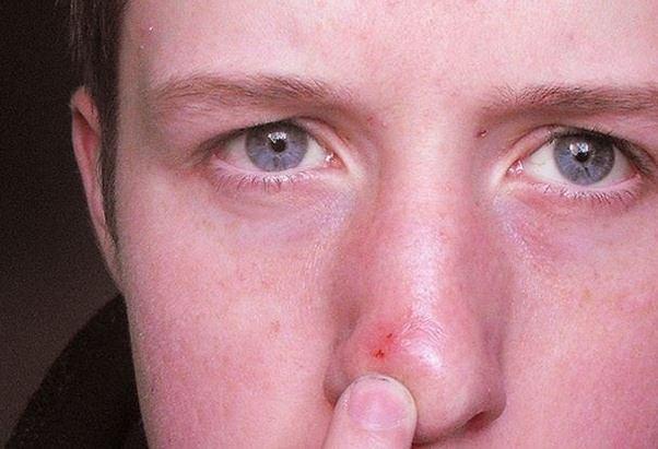 Recurring facial lesions nose cheek