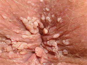 best of Pictures Hpv in anus