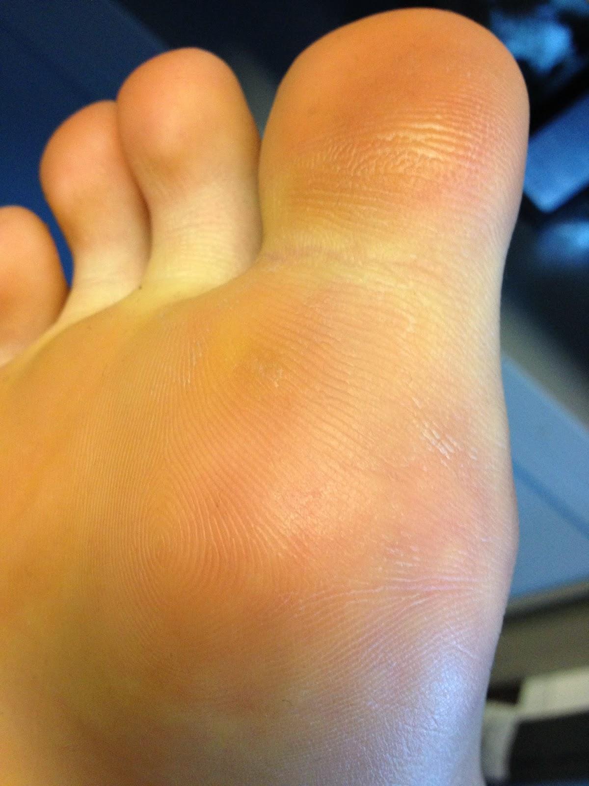 best of Of bottom foot Planters on wart left