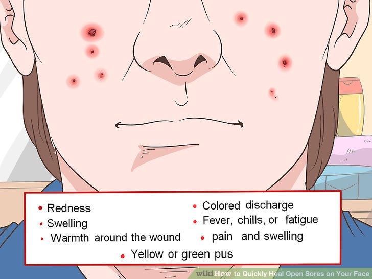 best of Sores Facial acne