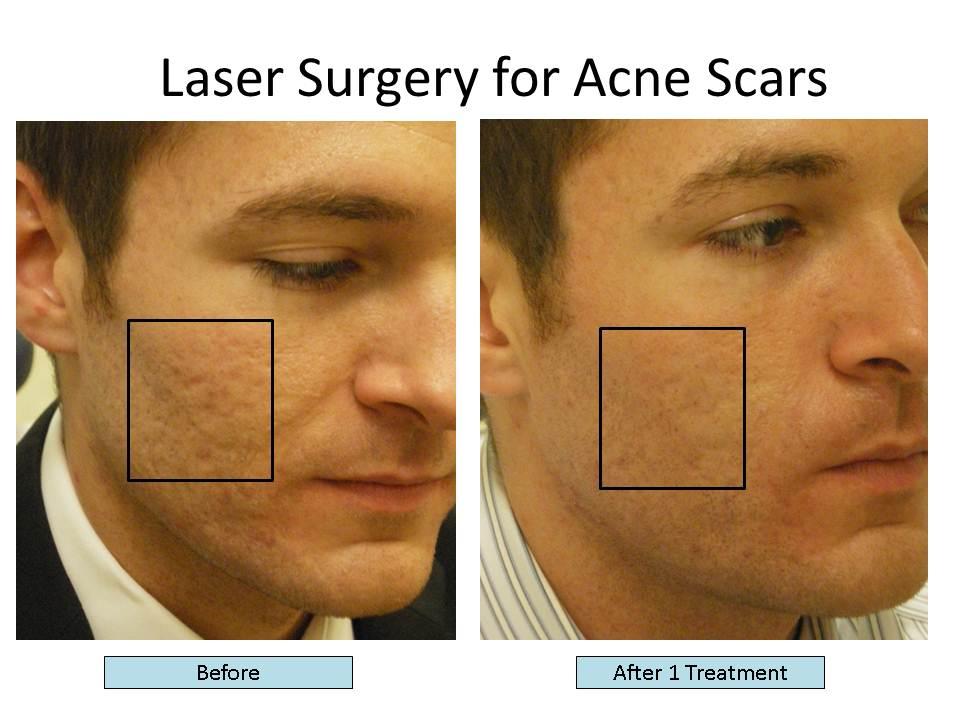 Herald reccomend Laser treatment for facial scars