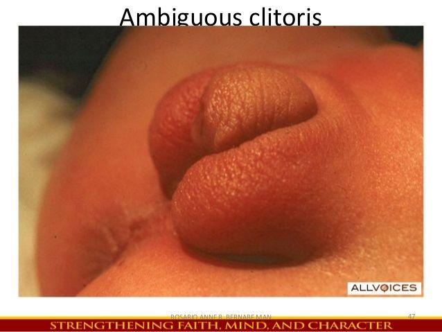Abnormal clitoris size