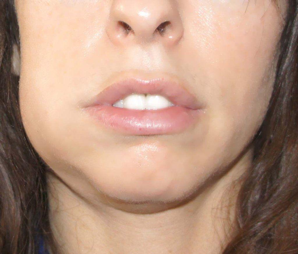 Absessed tooth and facial swelling