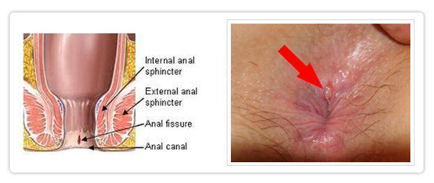 Anal fissure abscess or fistula