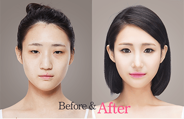 Scratch reccomend Asian plastic surgery pictures