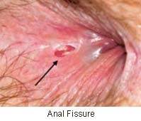 Anal fissure herpes pictures