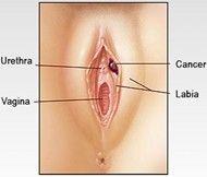 Black sore on vagina