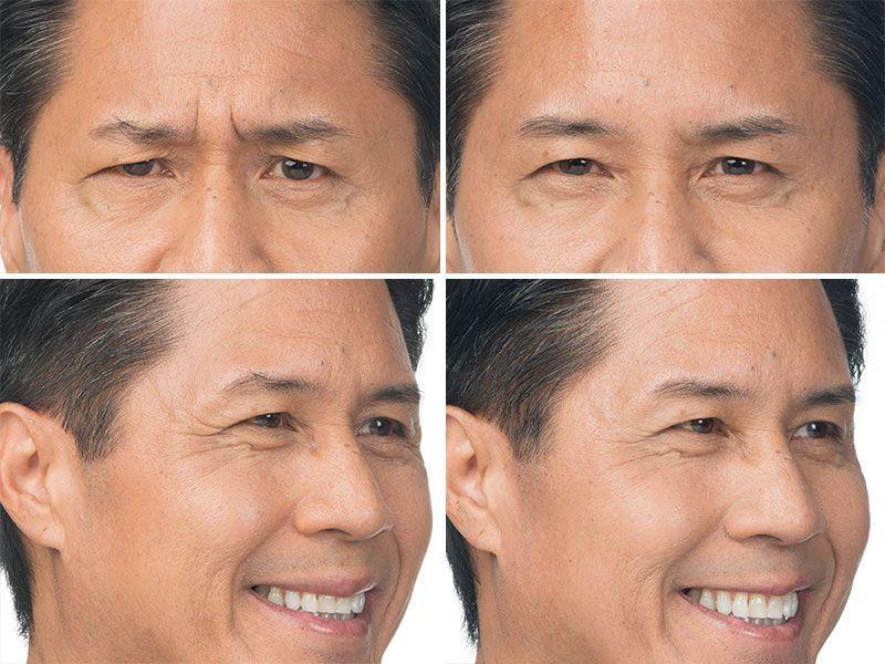 Botox facial reduce vancouver wrinkle