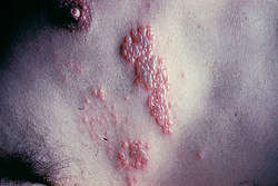 Herpes facial and genital concurrently