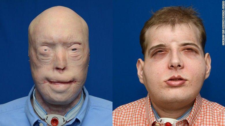 Facial partial transplant
